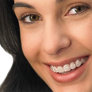 Batom x Aparelho nos dentes